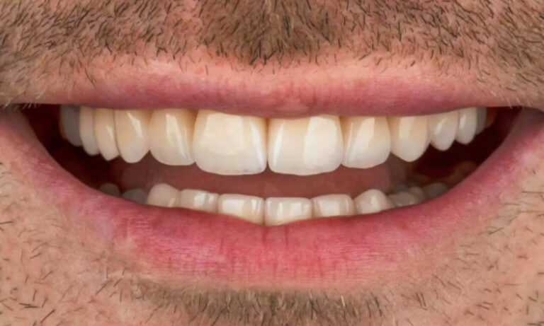 How are Veneers Installed?. Photo after