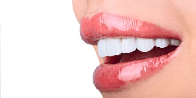 Veneers. Illustrative image