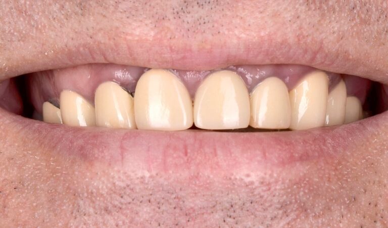 What are Complete Dentures, Removable Partial Dentures, and Bridges?. Photo before