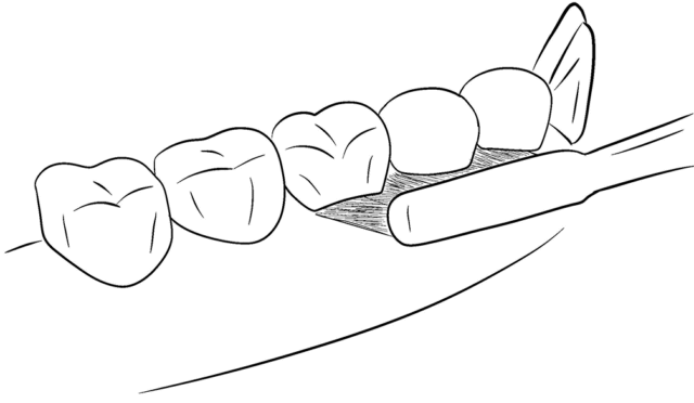 Уход за имплантами Иллюстрация