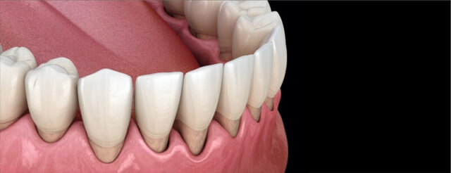 The gum recedes: what Is next?