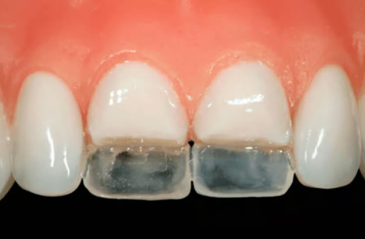 Direct restoration. Photo 3