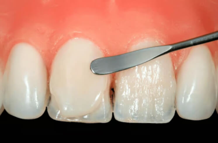 Direct restoration. Photo 4