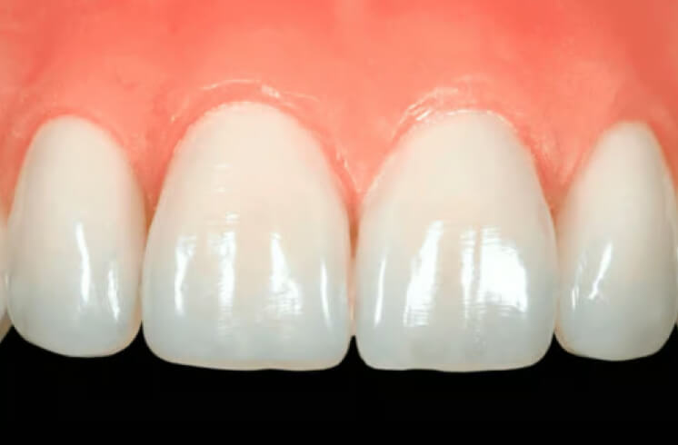 Direct restoration. Photo 1