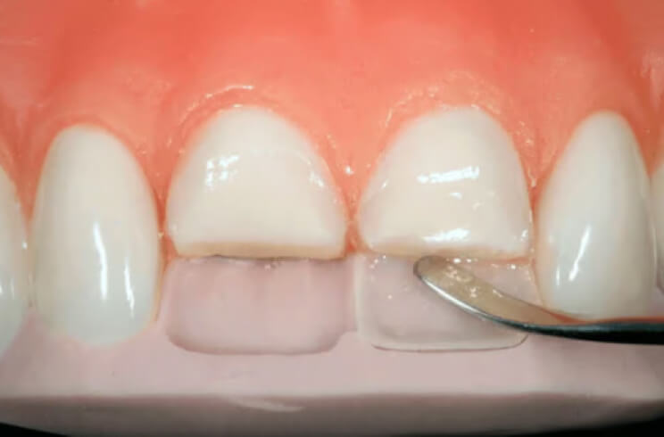 Direct restoration. Photo 2