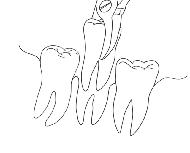 How long does the extraction take? Illustration