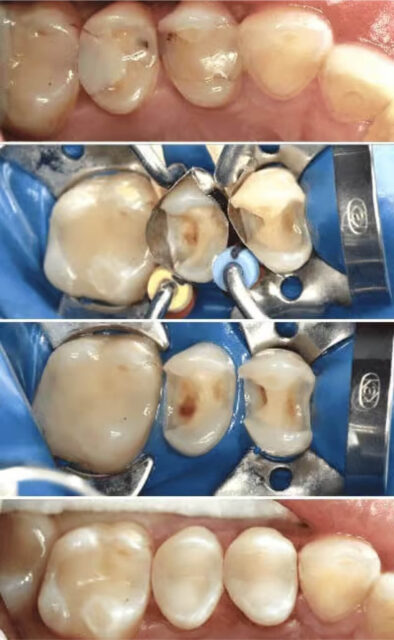 HOW DOES DIRECT DENTAL RESTORATION WORK? Illustration