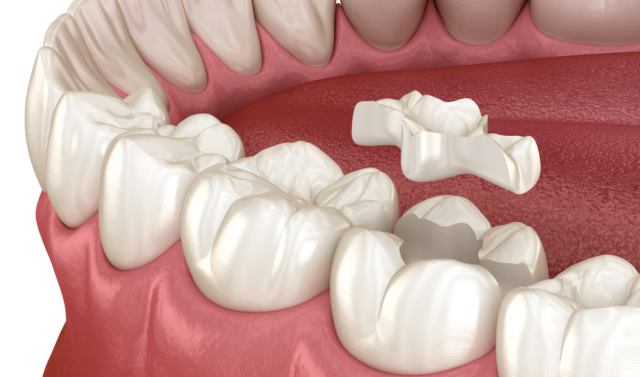 WHAT ARE INDIRECT TOOTH RESTORATIONS? Illustration