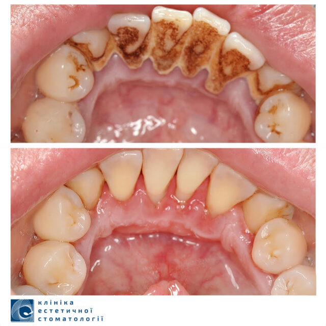 Gum Recession: What to Do When the Gum Recedes photo