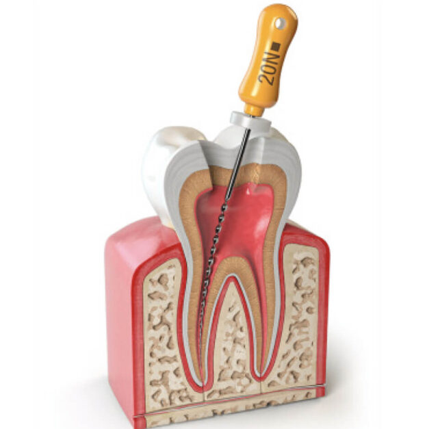 Лечение корневых каналов