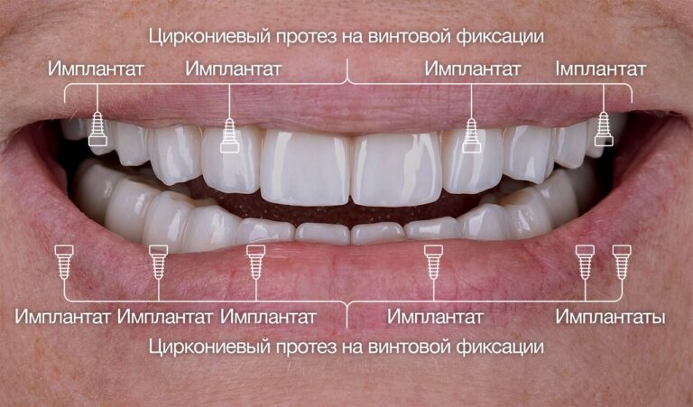 Имплантологическое лечение пациента с тяжелой формой пародонтита