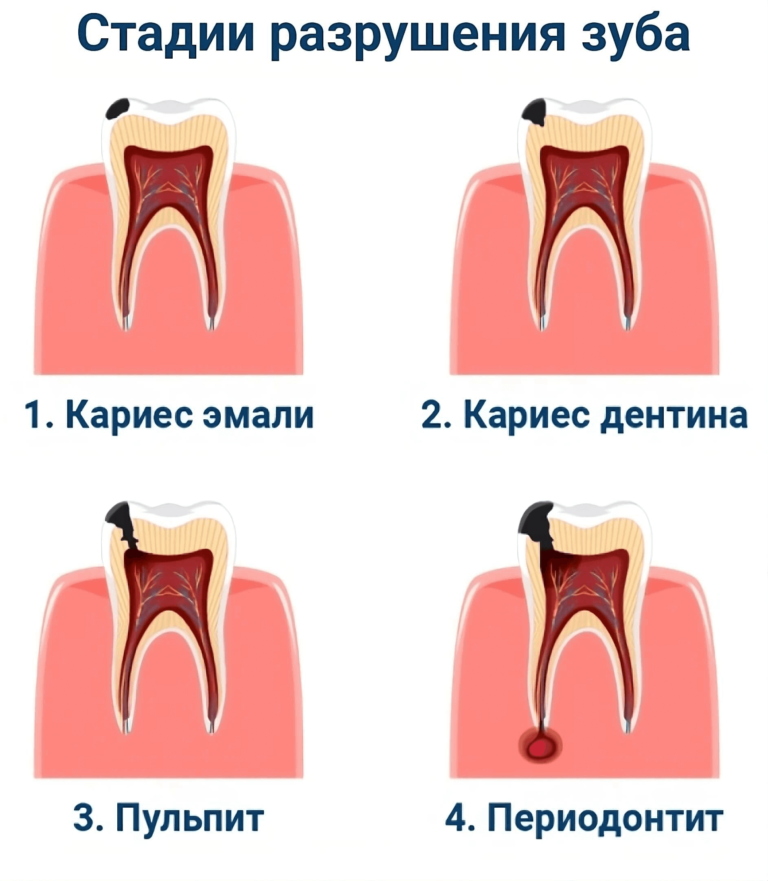 Стадии разрушения зуба