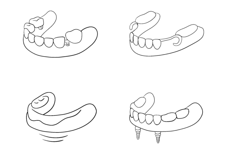 tooth-crown+inlay-011-pl15