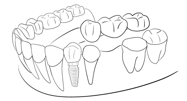tooth-crown+inlay-091-pl15