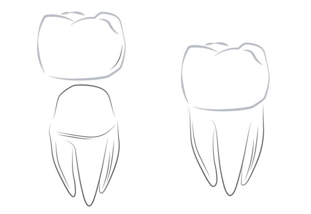Crowns Placement Illustration