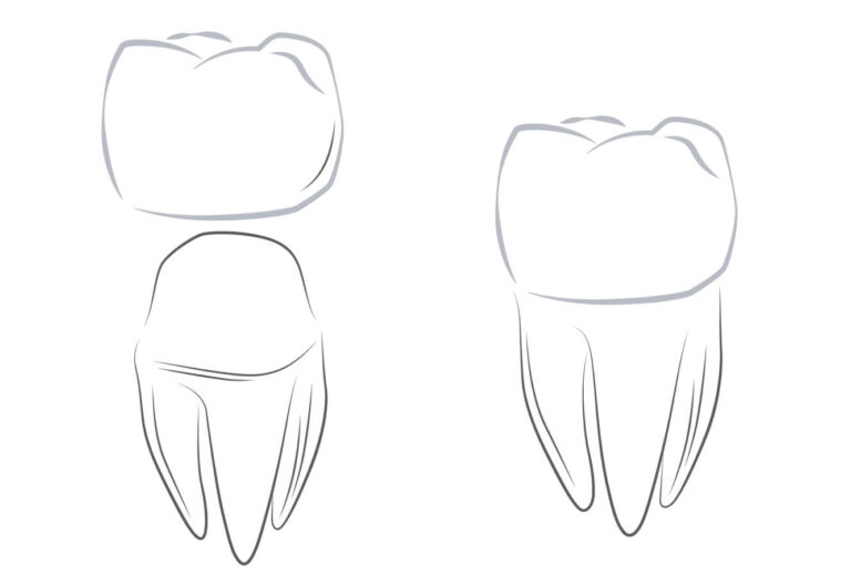 tooth-crown+inlay