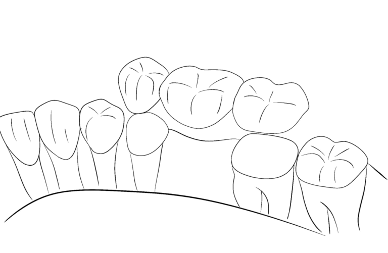 tooth-crown+inlay-pl15