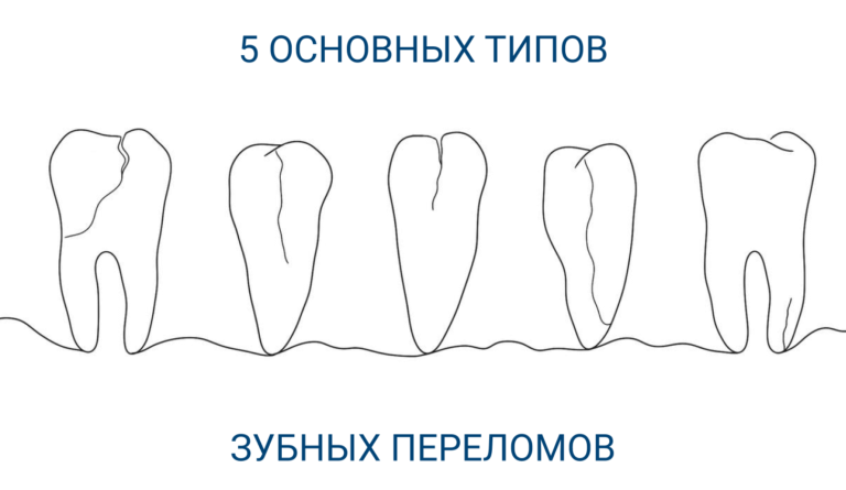 Зубные переломы