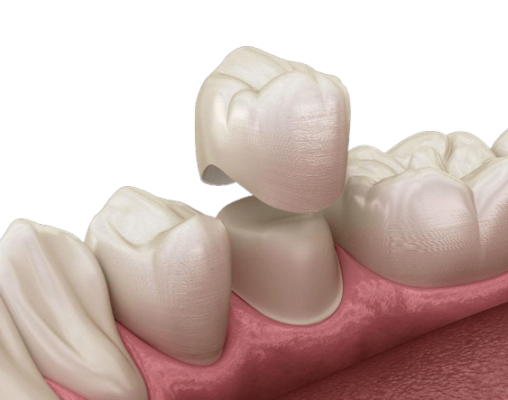 All-ceramic crowns Illustration