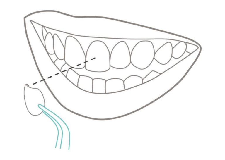 veneers