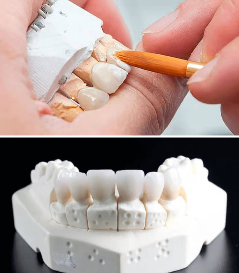 veneers-image-05