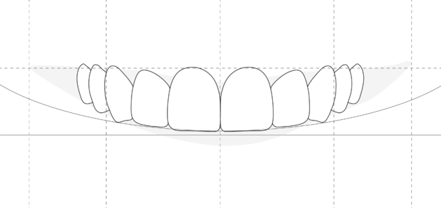 Veneers not recommended: Illustration