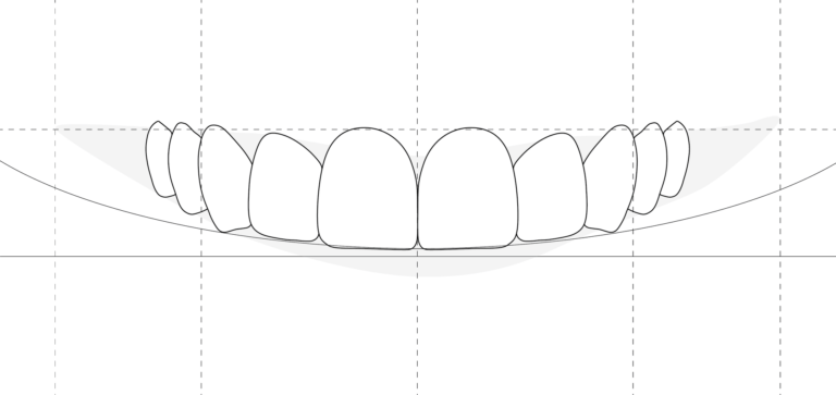 veneers-image-25