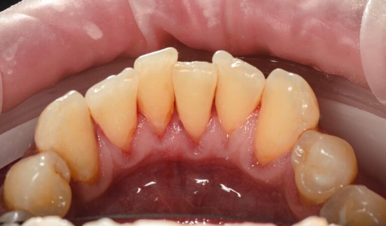 ORAL HYGIENE ROUTINE. Photo after