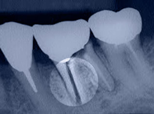 Longitudinal fracture of the tooth root