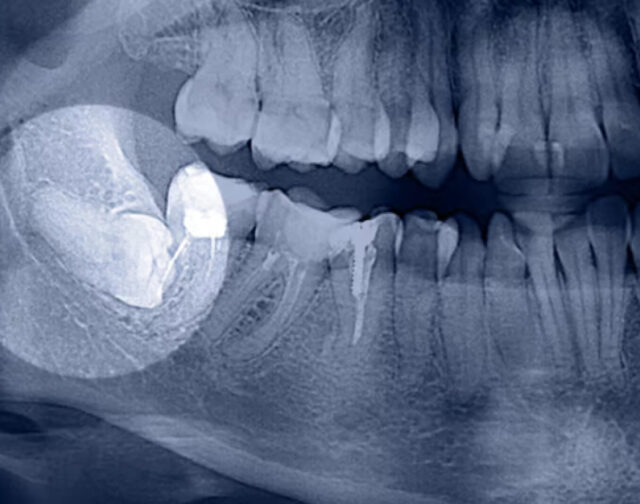 Поздовжній перелом кореня зуба