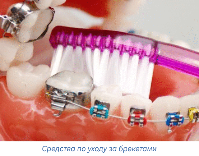 Средства по уходу за брекетами