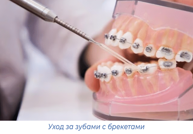 Уход за зубами с брекетами