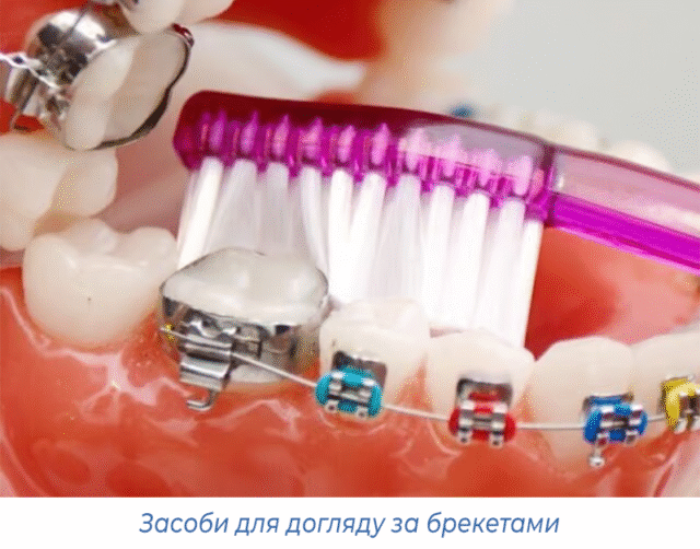 Засоби для догляду за брекетами