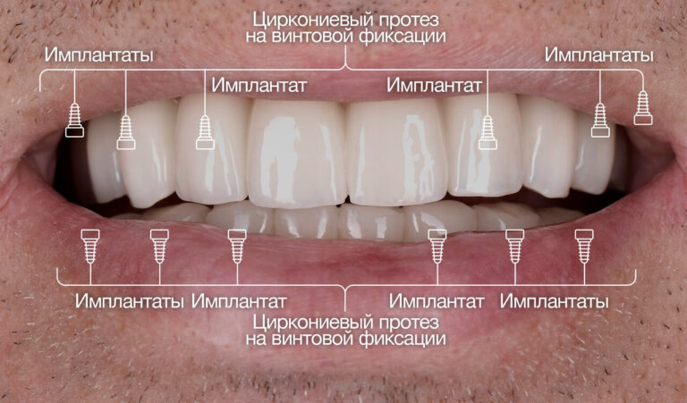 Имплантация и протезирование пациента с множественным осложненным кариесом на верхней челюсти