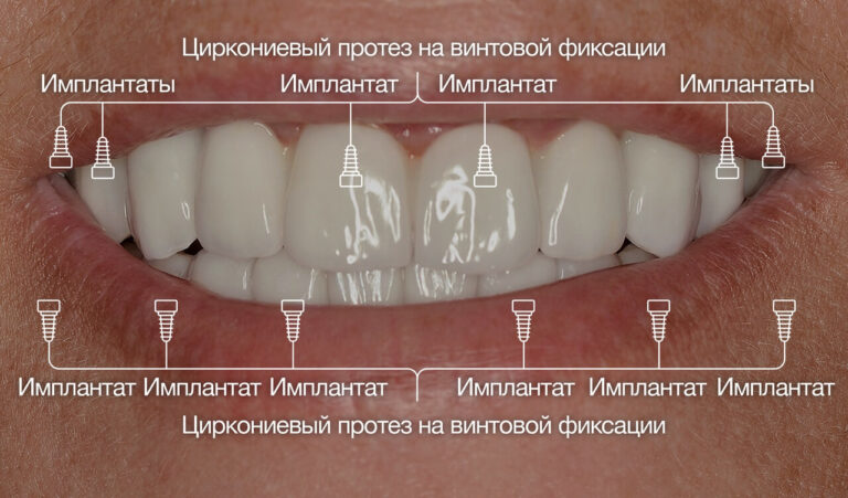 Имплантологическое лечение со значительной потерей зубов вследствие осложнённого кариеса