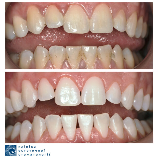 Blackened Tooth near the Gum Line: Why Do Teeth Darken photo
