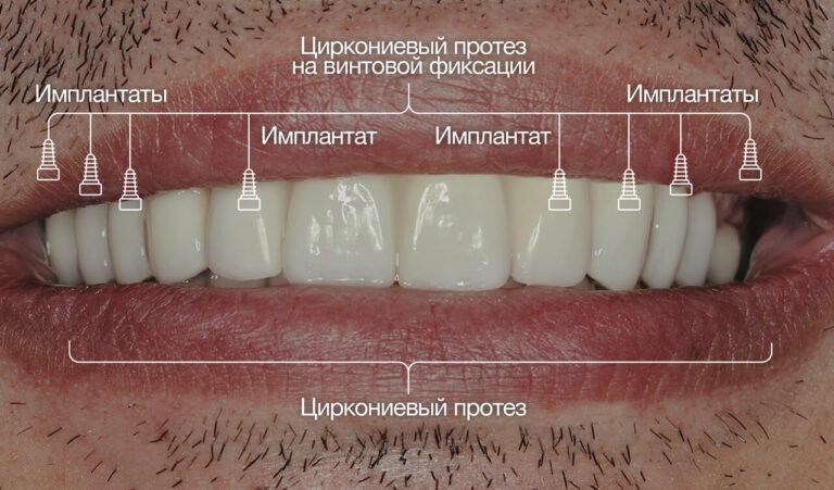 Коррекция травмирующей окклюзии и имплантологическое лечение при глубоком травмирующем прикусе