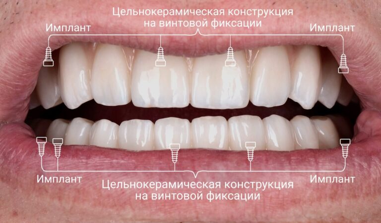 Реабилитация пациента с тяжёлой формой пародонтита имплантатами Nobel Biocare по протоколу All-on-4