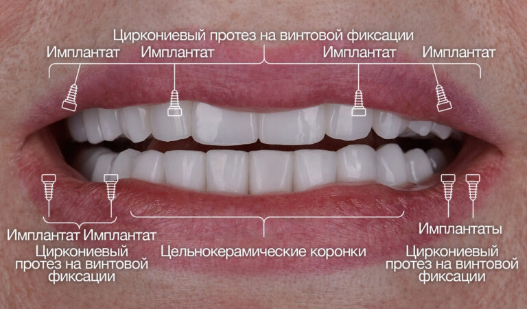 Реконструкция обеих челюстей циркониевыми конструкциями с опорой на имплантаты