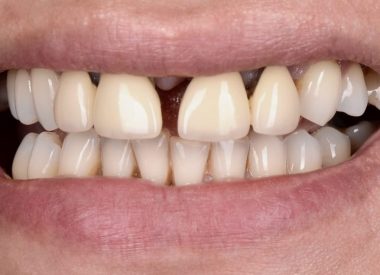 Пациентка обратилась с жалобами на подвижность фронтальных зубов верхней челюсти, не устраивал эстетический вид коронок и своих зубов.