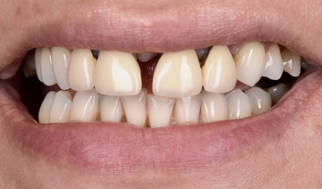 The patient complained about the upper anterior teeth mobility and was dissatisfied with the aesthetic appearance of the crowns and her teeth.