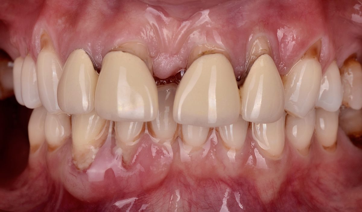 Some of the teeth on the lower jaw were also missing. In addition, there was multiple gingival recession. The patient received periodontal treatment, immediate post-extraction implantation of four upper incisors in the area of the upper lateral incisors and the missing lower jaw teeth.