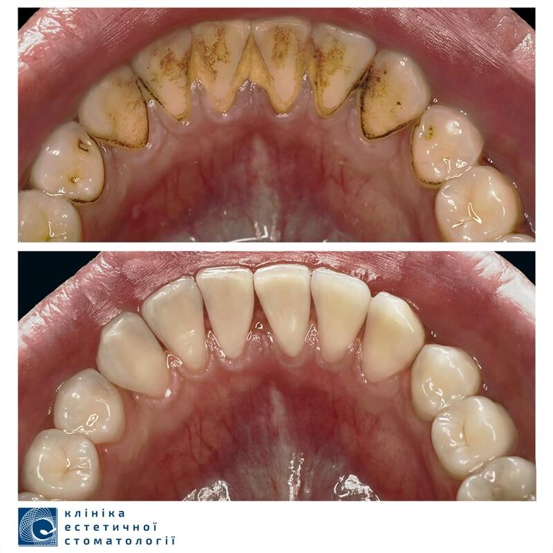 Фото емалі зубів після чішєння