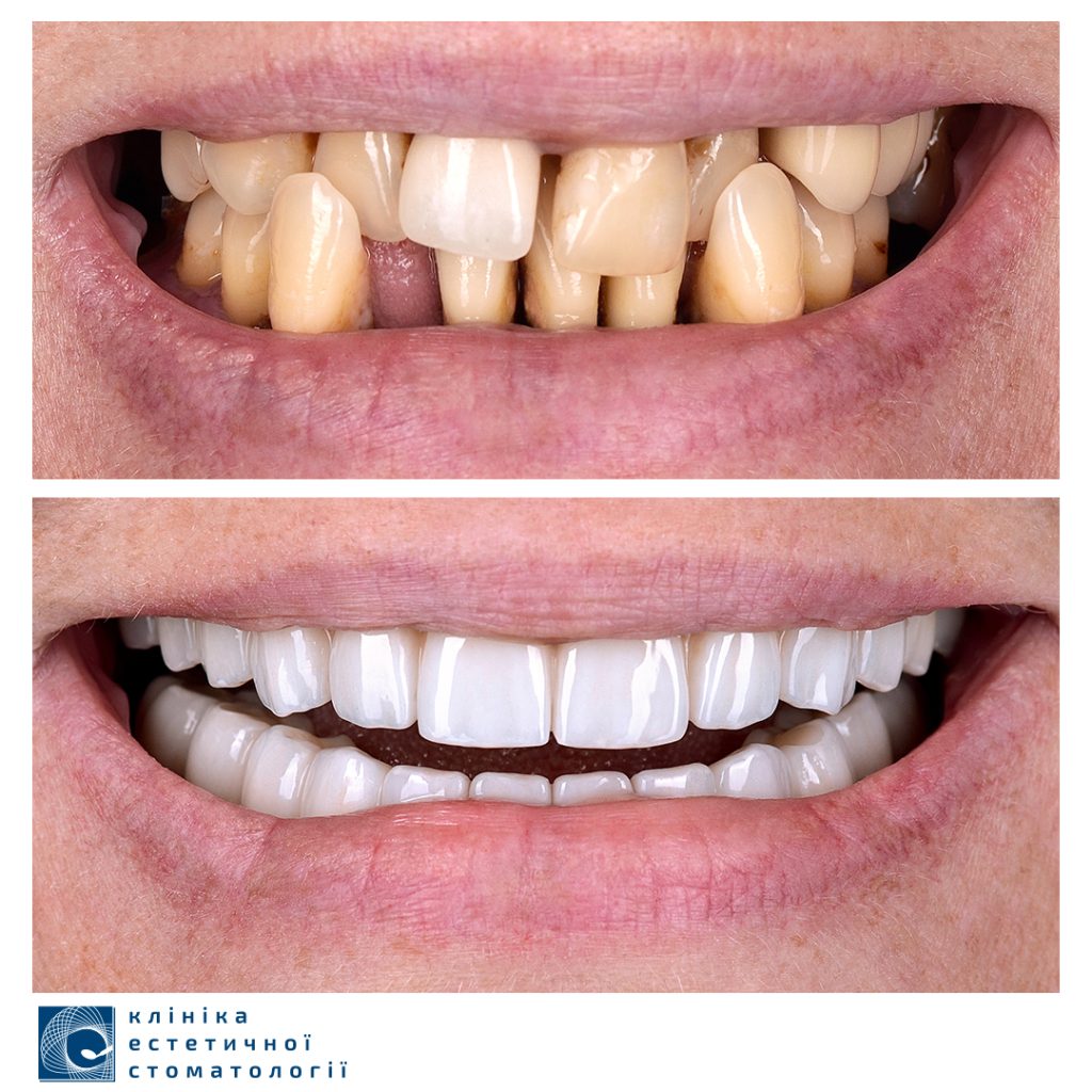 Veneer Replacement — How Often Do You Have to Replace Your Veneers