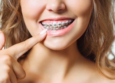 Braces Removal Procedure: Frequently Asked Questions