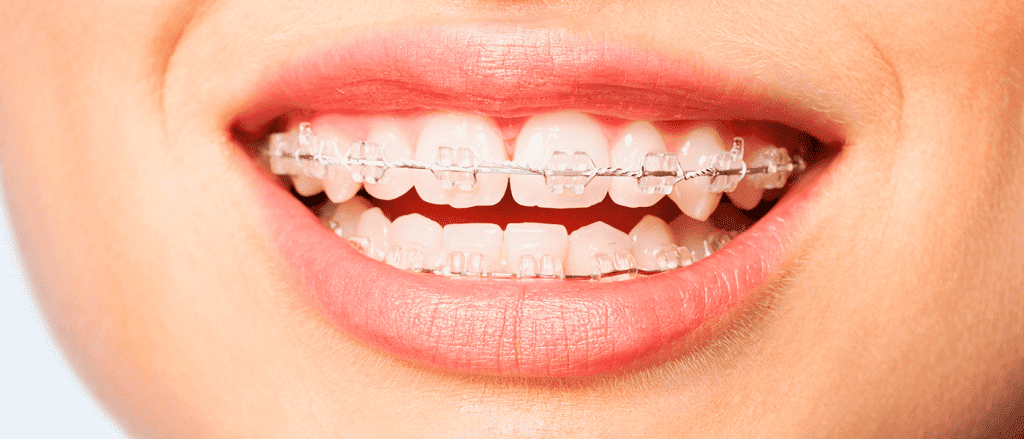 What Are The Stages of Orthodontic Treatment