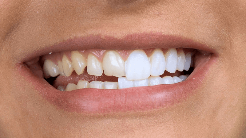 What types of modern dentures are better to choose