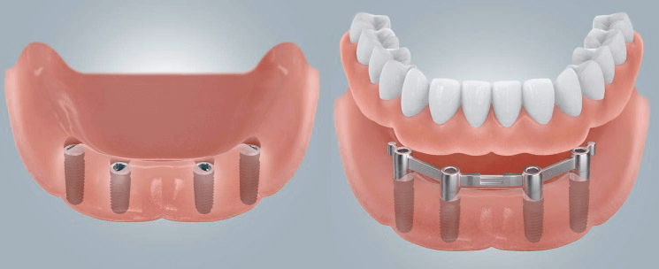 Implant-retained