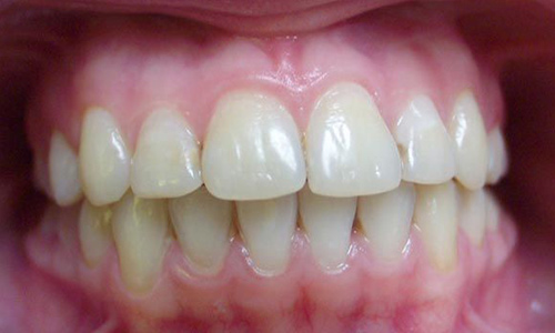 Чому передні зуби можуть випинати
