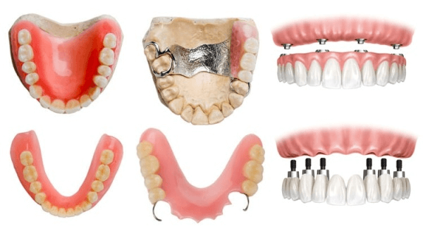 Современные зубные протезы и их виды
